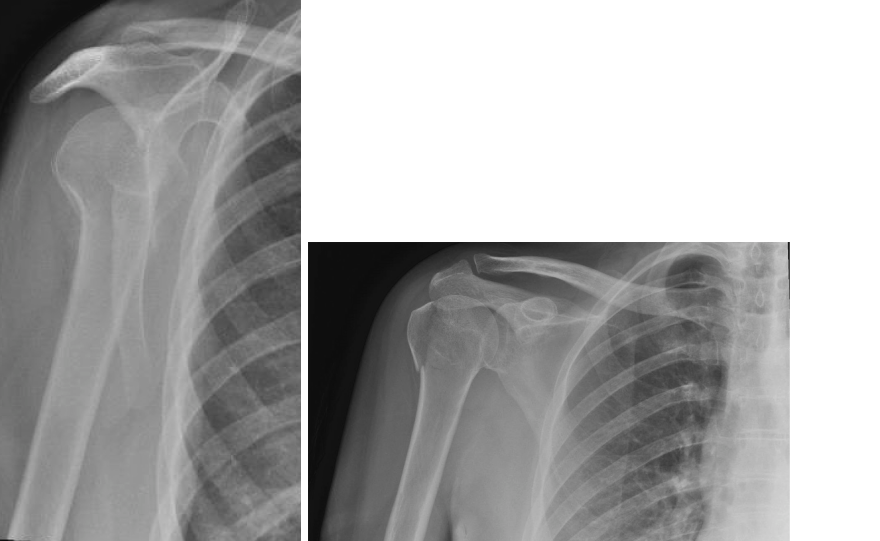 Greater Tuberosity Fracture: Expert Diagnosis and Treatment Strategies