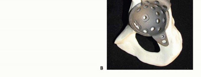 Illustration 9 for Pelvic Discontinuity: Understanding Superior and Inferior Separation