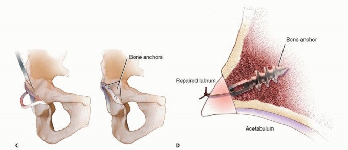 Illustration 15 for Surgical Hip Dislocation Safety: The Branch of the MFCA's Vital Role