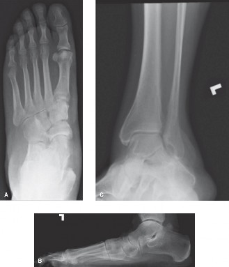 Solving Chronic Foot Pain: Is Tibial Tendon Debridement for You?