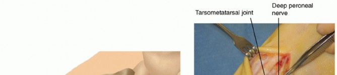 Illustration of medial capsular closure - Dr. Mohammed Hutaif