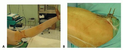 صورة طبية: ترميم مفصل الورك: الحل الأمثل للحفاظ على عظم رأس الفخذ في صنعاء مع الدكتور محمد هطيف