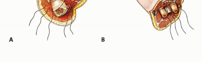صورة توضيحية لـ بتر الذراع فوق وتحت الكوع: متى ولماذا يصبح ضرورة طبية؟ دليل شامل من الأستاذ الدكتور محمد هطيف