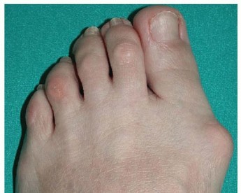 Minimally Invasive Hallux Valgus Correction: Is SERI Right For You?
