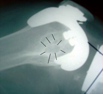 Illustration 2 for Uncemented Stems in Revision: A Guide to Success & Pitfalls