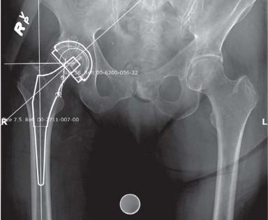Illustration of approaches posterolateral surgical - Dr. Mohammed Hutaif