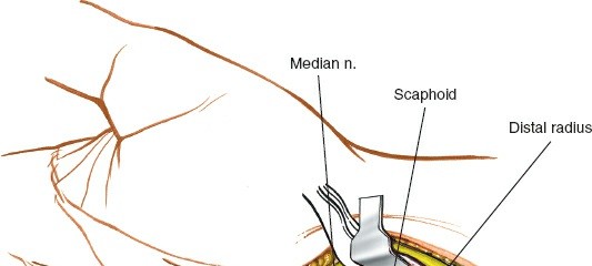 Illustration 74 for Essential Surgical Approaches: Uncover Every Aspect of the Wrist