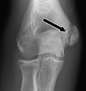 Decoding Little League Elbow: Symptoms, Diagnosis, Treatment