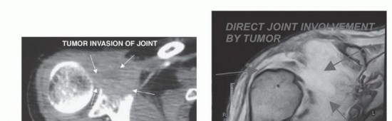 صورة طبية: استئصال أورام الكتف مع الحفاظ على الطرف: أحدث التقنيات لنتائج مثالية مع الأستاذ الدكتور محمد هطيف