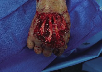 Critical Hand Wounds: The Reverse Radial Forearm Flap Solution