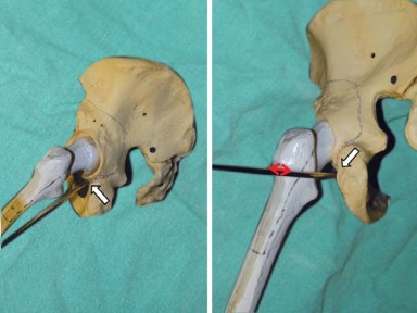Illustration 3 for Mastering Soft Tissue Balancing for Optimal THR Outcomes