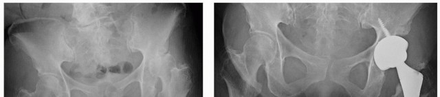 صورة طبية: تثبيت مفصل الورك بدون أسمنت: دليل شامل لمرضى استبدال الورك مع الأستاذ الدكتور محمد هطيف