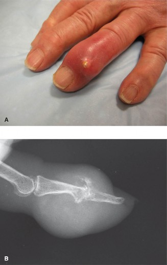 Elderly Hand Pain? Diagnosing Acute Tophaceous Gout Correctly