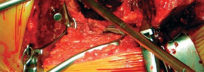 صورة طبية: طول عمر مكون الحُق الأسمنتي في مفصل الورك: مفتاح الاستقرار والديمومة مع الأستاذ الدكتور محمد هطيف في صنعاء