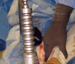 Illustration 19 for Minimize Pain, Maximize Recovery: TKA with Parapatellar