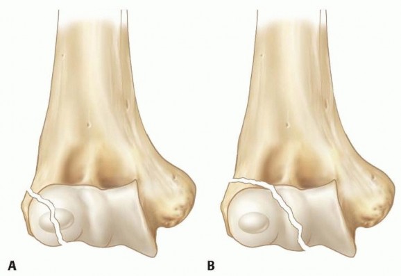 Open Reduction and Internal Fixation of Displaced Lateral Condyle Fractures of the Humerus