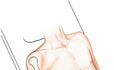 Illustration 56 for Mastering Approaches to the Upper Third of the Radius