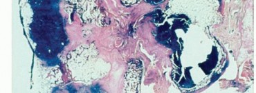 Illustration 9 for Beyond Amputation: Total Femur Resection with Endoprosthetics