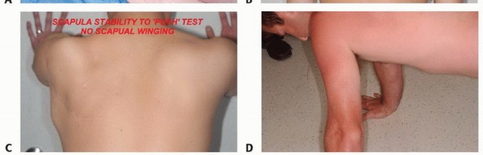 صورة طبية: الاستئصال الكلي للوح الكتف: دليل شامل للمرضى حول الجراحة، إعادة البناء والنتائج مع الأستاذ الدكتور محمد هطيف في صنعاء