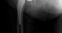 Illustration 19 for Mastering Direct Anterior Approach Hip Arthroplasty Without a Traction Table