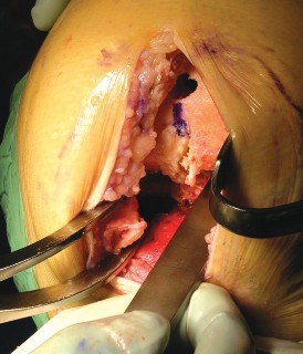 Illustration 22 for Cemented TKA Figure: Your Visual Guide to Surgical Success