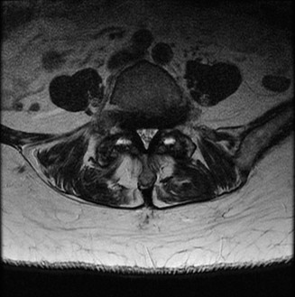 Illustration 27 for Adjacent Segment Degeneration: Your Next Spine Case Solved