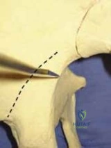 Open Reduction and Plate Fixation of Metacarpal Fractures: A Comprehensive Surgical Guide