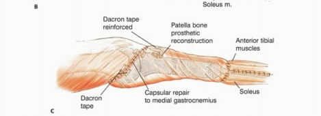 صورة طبية: معالجة الأورام المعقدة في قصبة الساق القريبة حلول الحفاظ على الأطراف