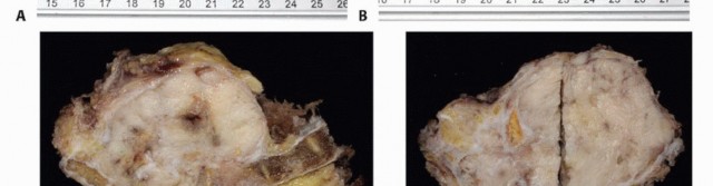 صورة طبية: جراحة أورام العجز: الحفاظ على وظائف الأمعاء والمثانة مع الأستاذ الدكتور محمد هطيف في صنعاء