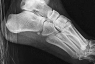 Illustration 3 for Partial Articular Fractureplate Fixation: Restore Anatomy