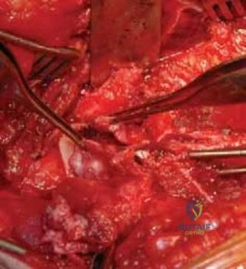 Contrecoup Lesion Biomechanics