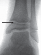 Pediatric Ankle Fractures: Management to Prevent Long-Term Issues