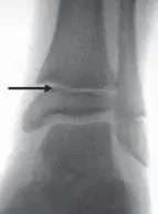 كسور الكاحل عند الأطفال: دليل شامل للوالدين من التشخيص إلى التعافي مع الأستاذ الدكتور محمد هطيف