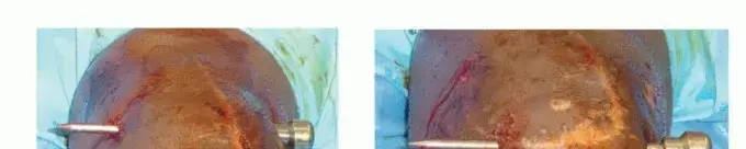 صورة توضيحية لـ تيبس الركبة (فقدان نطاق الحركة): دليل المريض الشامل للتشخيص والعلاج والتعافي