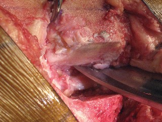 Illustration 34 for Posterior Stabilized Technique: Essential Insights for TKA Success