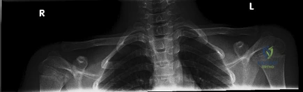 Musculoskeletal Tuberculosis and Atypical Infections: Operative Management