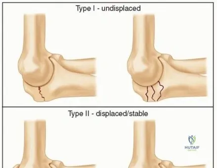 Illustration of internal fixation of fractures - Dr. Mohammed Hutaif