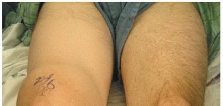 Painful Knee Swelling? Explore Synovitis of the Knee Solutions