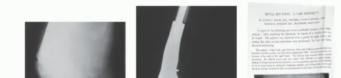 صورة توضيحية لـ استبدال عظم الفخذ البعيد: مفتاح إنقاذ الأطراف الحديث في جراحة الأورام العظمية