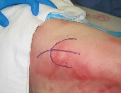 صورة توضيحية لـ استبدال مفصل الورك بالحد الأدنى من التدخل الجراحي: تقنيات متقدمة، فوائد وتحديات