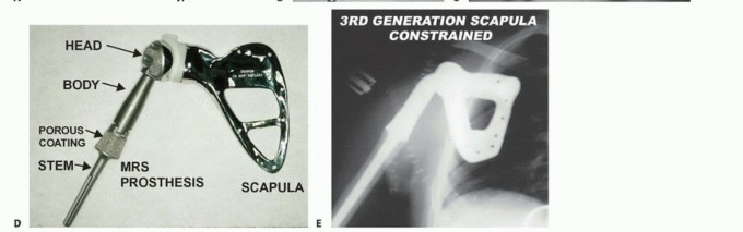 صورة طبية: استئصال أورام الكتف مع الحفاظ على الطرف: أحدث التقنيات لنتائج مثالية مع الأستاذ الدكتور محمد هطيف