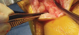 Illustration 25 for Posterior Stabilized Technique: Essential Insights for TKA Success