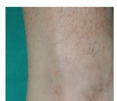 Insertional Achilles Tendinopathy: Causes, Symptoms, & Relief