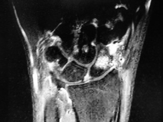 Illustration 4 for Christine M Kleinert Discussion: Solving Difficult Wrist Fractures