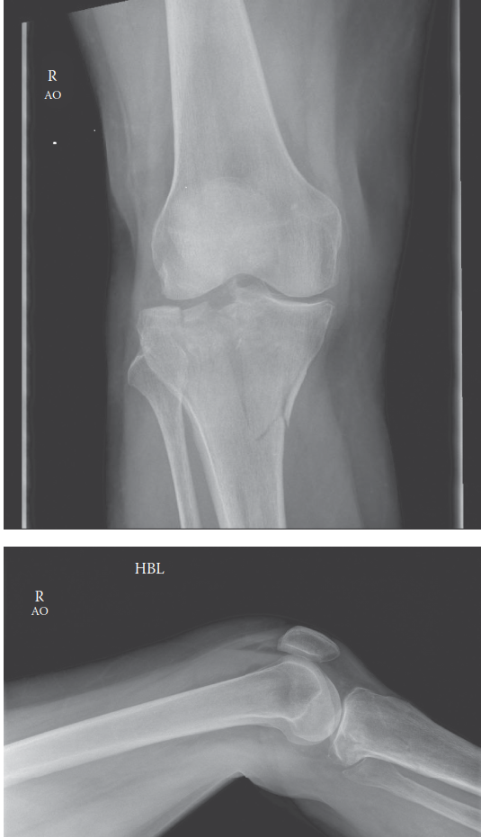 Illustration of plateau fracture tibial - Dr. Mohammed Hutaif