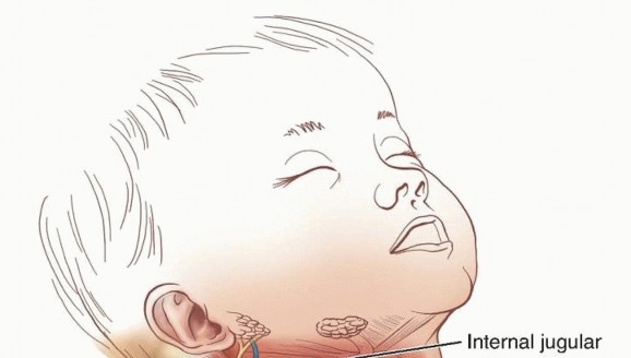 Congenital Muscular Torticollis: SCM Release for Better Neck Mobility