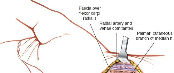 Illustration 184 for Essential Surgical Approaches: Uncover Every Aspect of the Wrist