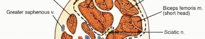 صورة توضيحية لـ استئصال ساركوما الفخذ الخلفي: الحفاظ على الأطراف ونتائج وظيفية مبهرة مع الدكتور محمد هطيف