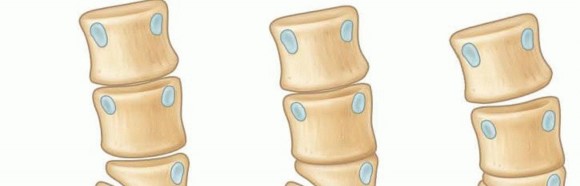 Illustration of hemivertebra excision hemivertebra - Dr. Mohammed Hutaif
