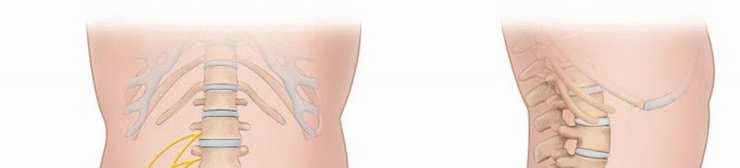 Illustration of lateral femoral cutaneous nerve - Dr. Mohammed Hutaif